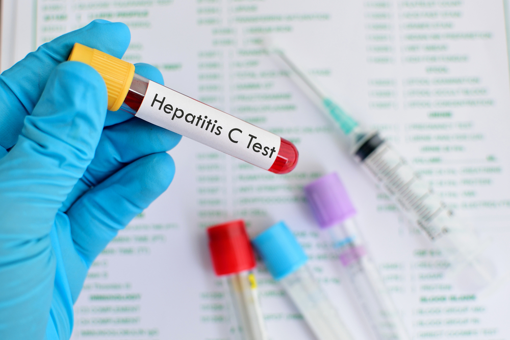 Szeptemberben ingyenes Hepatits C-szűrések az egész országban! |  EgészségKalauz