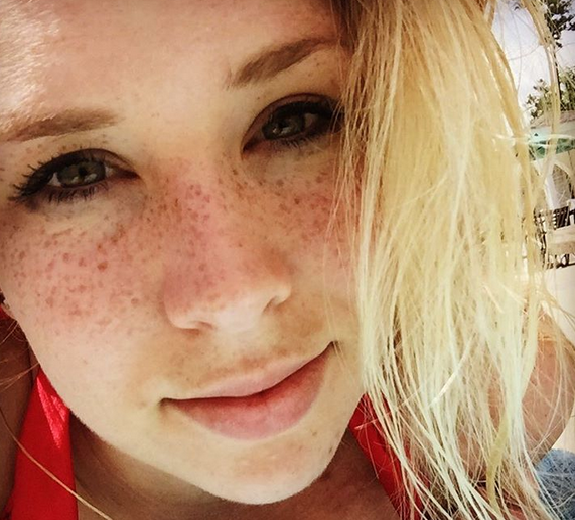 Freckling