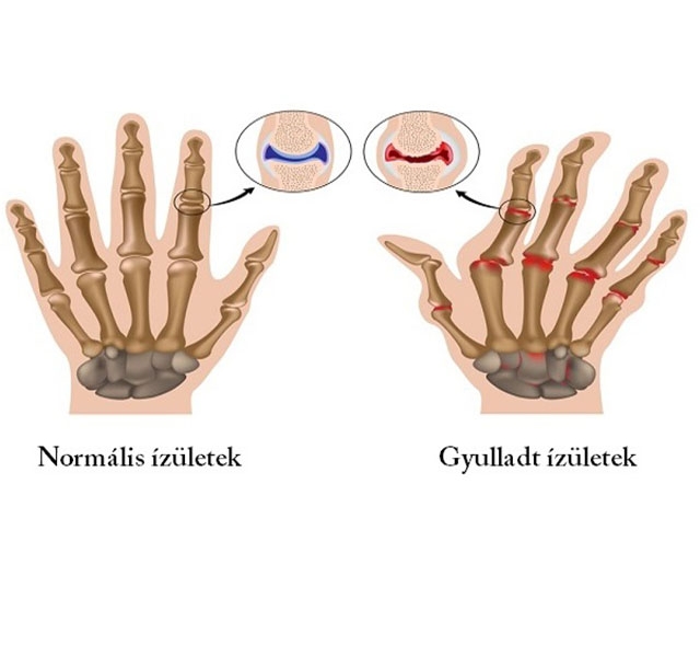 csukló fájdalom és gyulladás