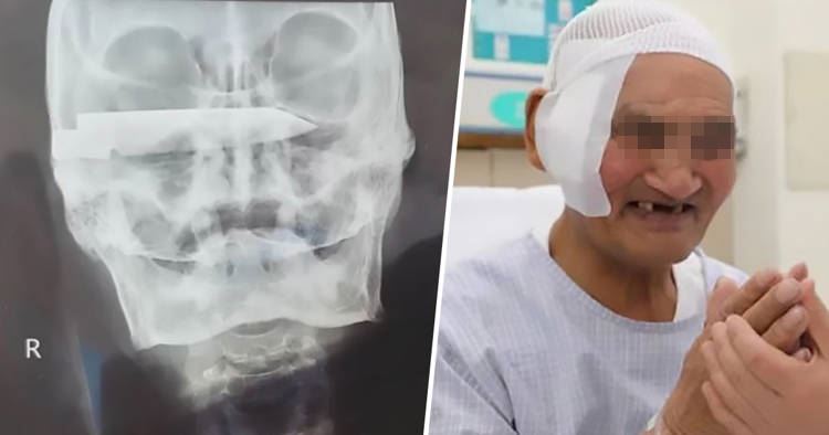 Doctors remove 4-inch-long rusty knife from man’s head 26 years after he was stabbed (photos)