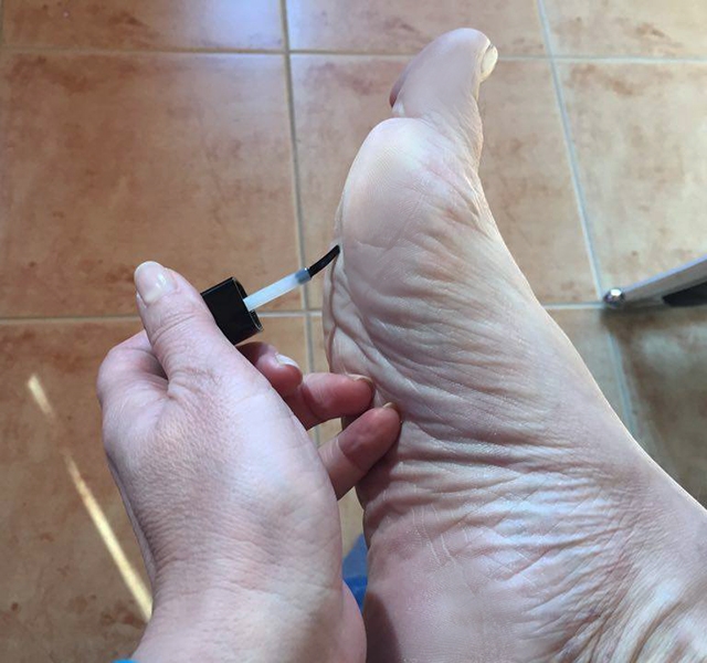 szemölcsök ültetése körömlakk vélemények