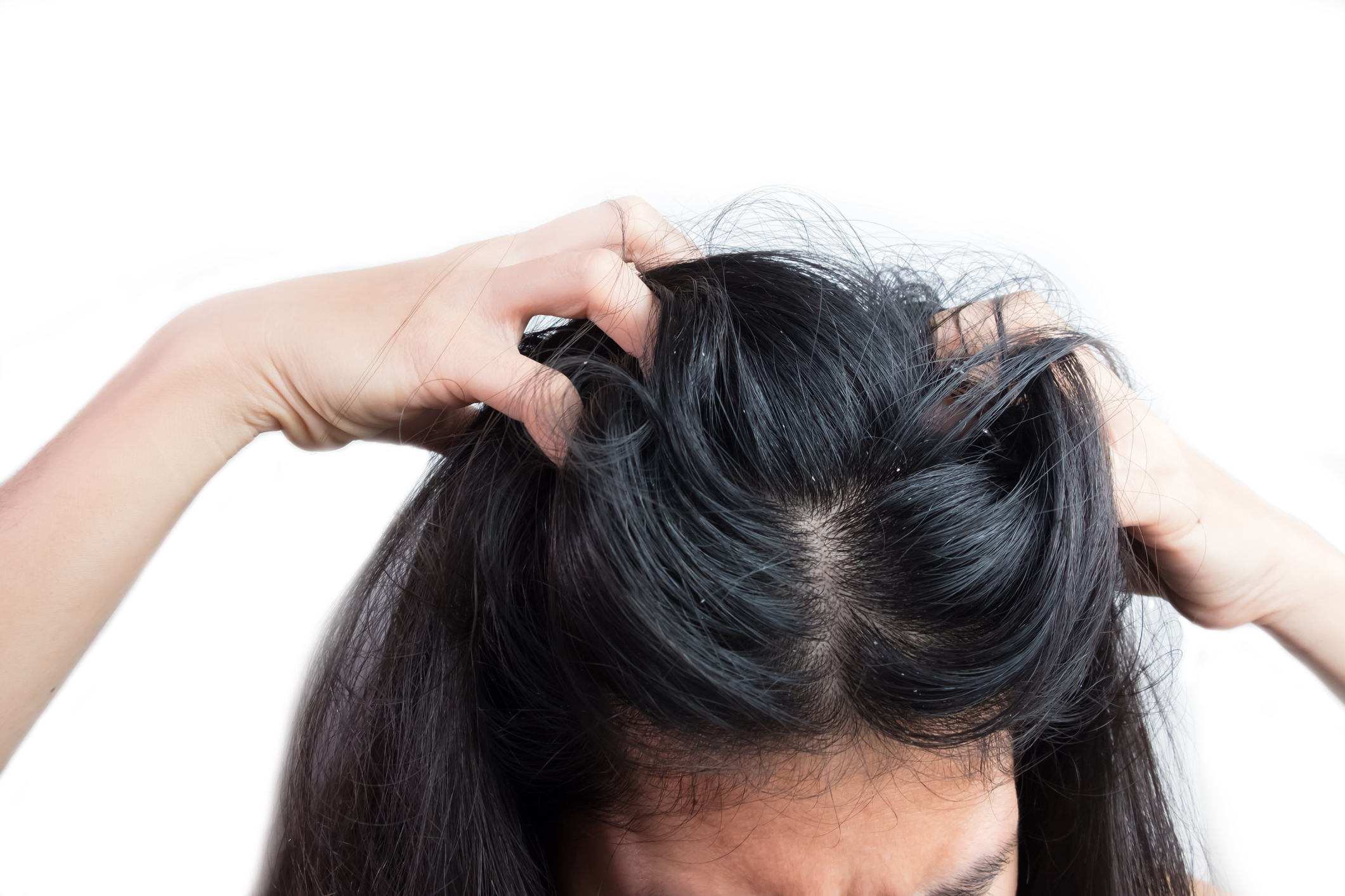 Korpás a haja, viszket a fejbőre? Ebből a vitaminból hiánya lehet! |  EgészségKalauz