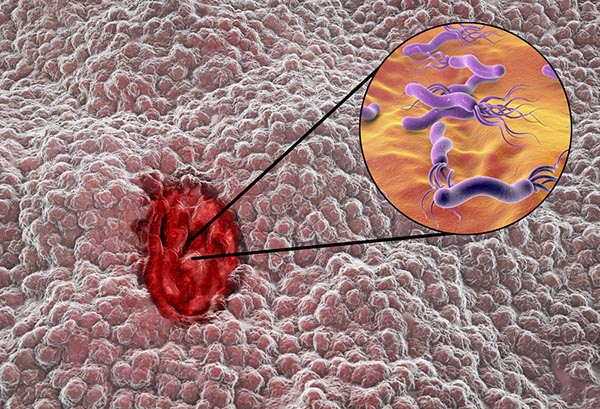 a gyomorfekély kezelése diabetes mellitus 2 módszertani ajánlások a cukorbetegség kezelésében