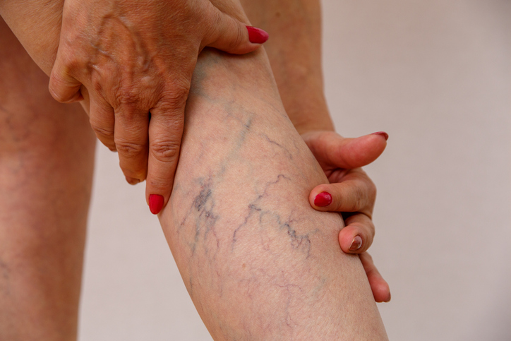 Visszér kezdeti szakasza a lábakon kezelés, Mitől alakulnak ki a visszerek? - Medicover Magánkórház
