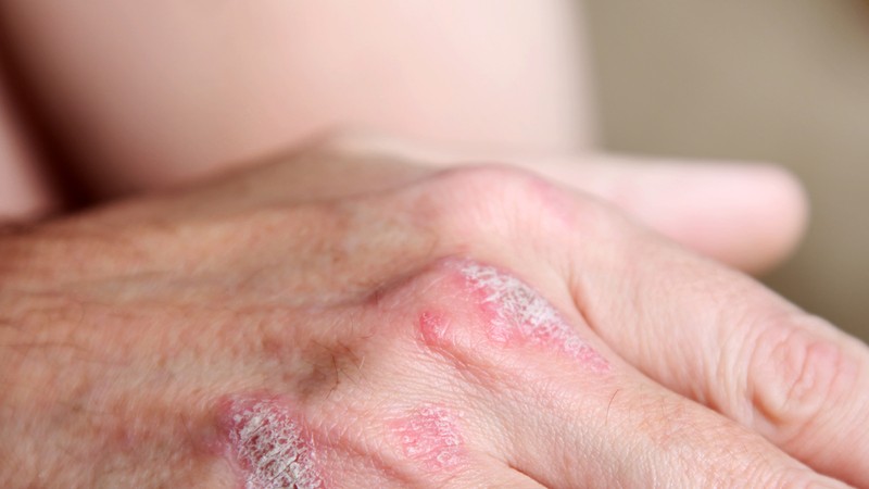 Se è possibile mangiare noci di pino a psoriasi