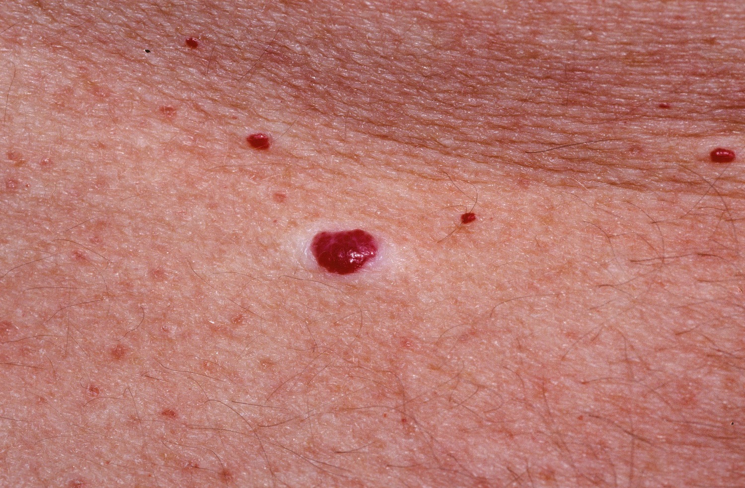 Piros pötty a bőrön: cseresznye-angioma