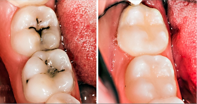 can a decaying tooth kill you