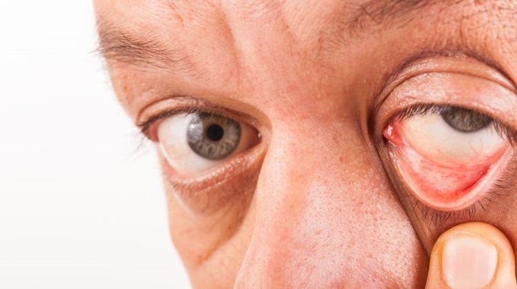 Kettős látás (Diplopia) tünetei és kezelése, Látás felhős foltok