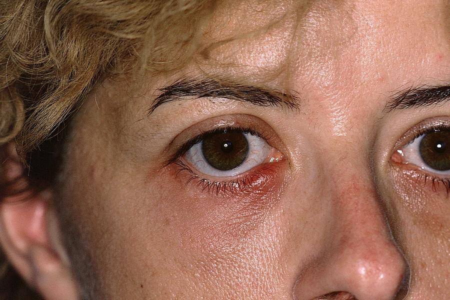 Jęczmień na oku czy można wyleczyć go jajkiem?