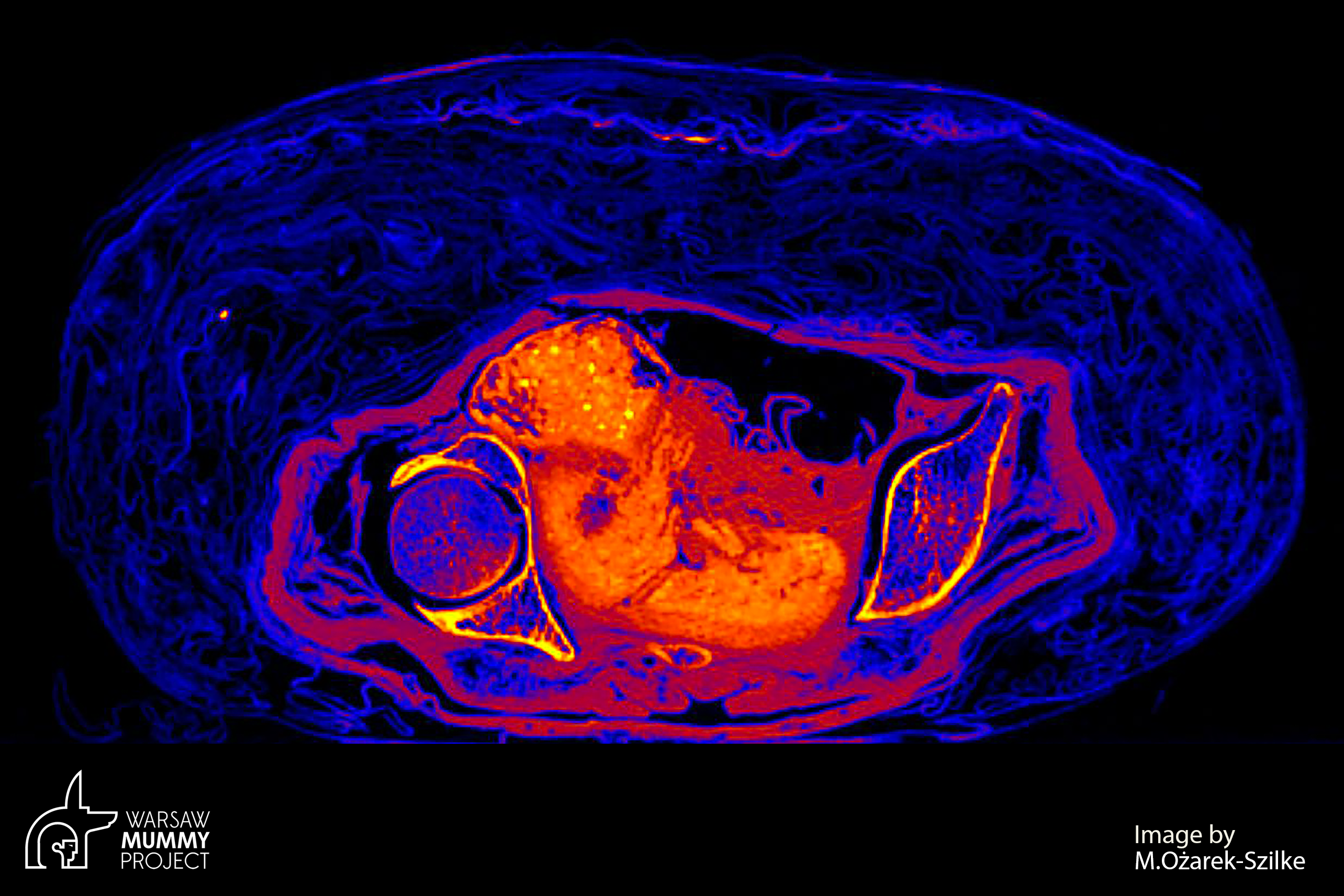 Obraz z tomografu przypomina płód odpowiadający 26.-30. tygodniowi ciąży