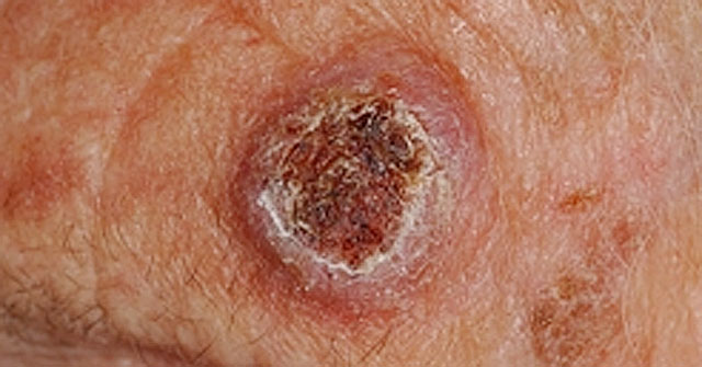 nursing care plans for psoriasis