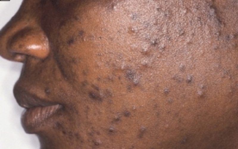 4 common habits that can make acne scars worst