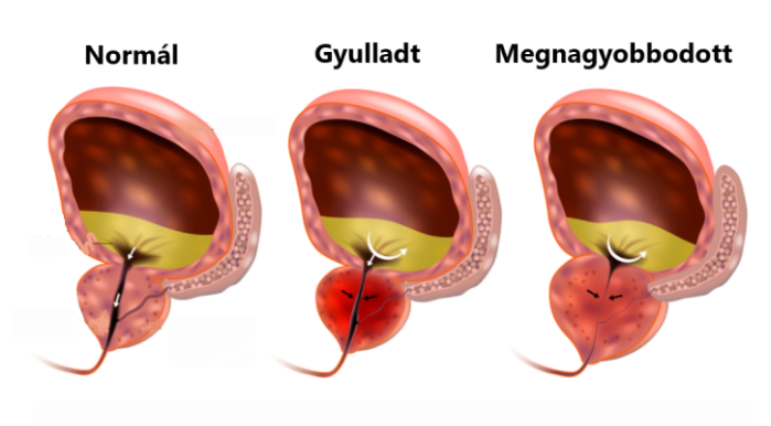 gyakorlat a prosztatitis)
