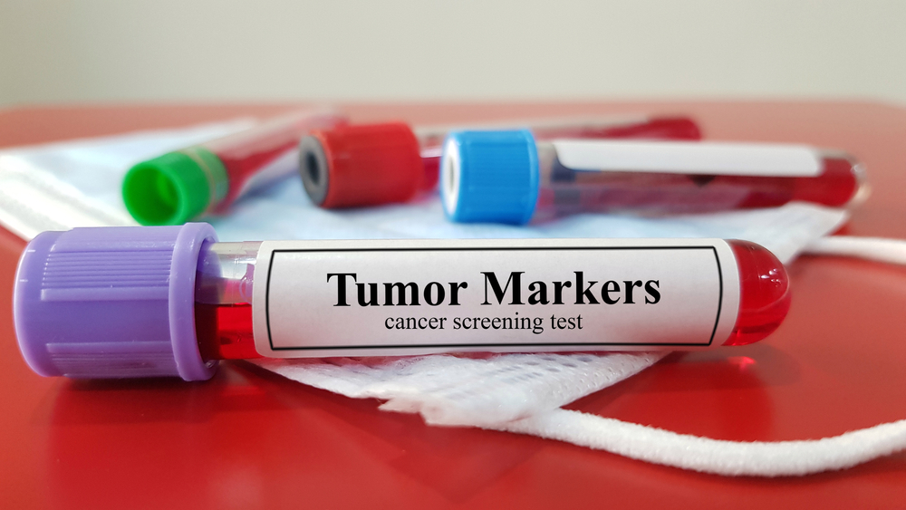 Tumormarkerek: ezzel jelzik a rákos elváltozást a leleten