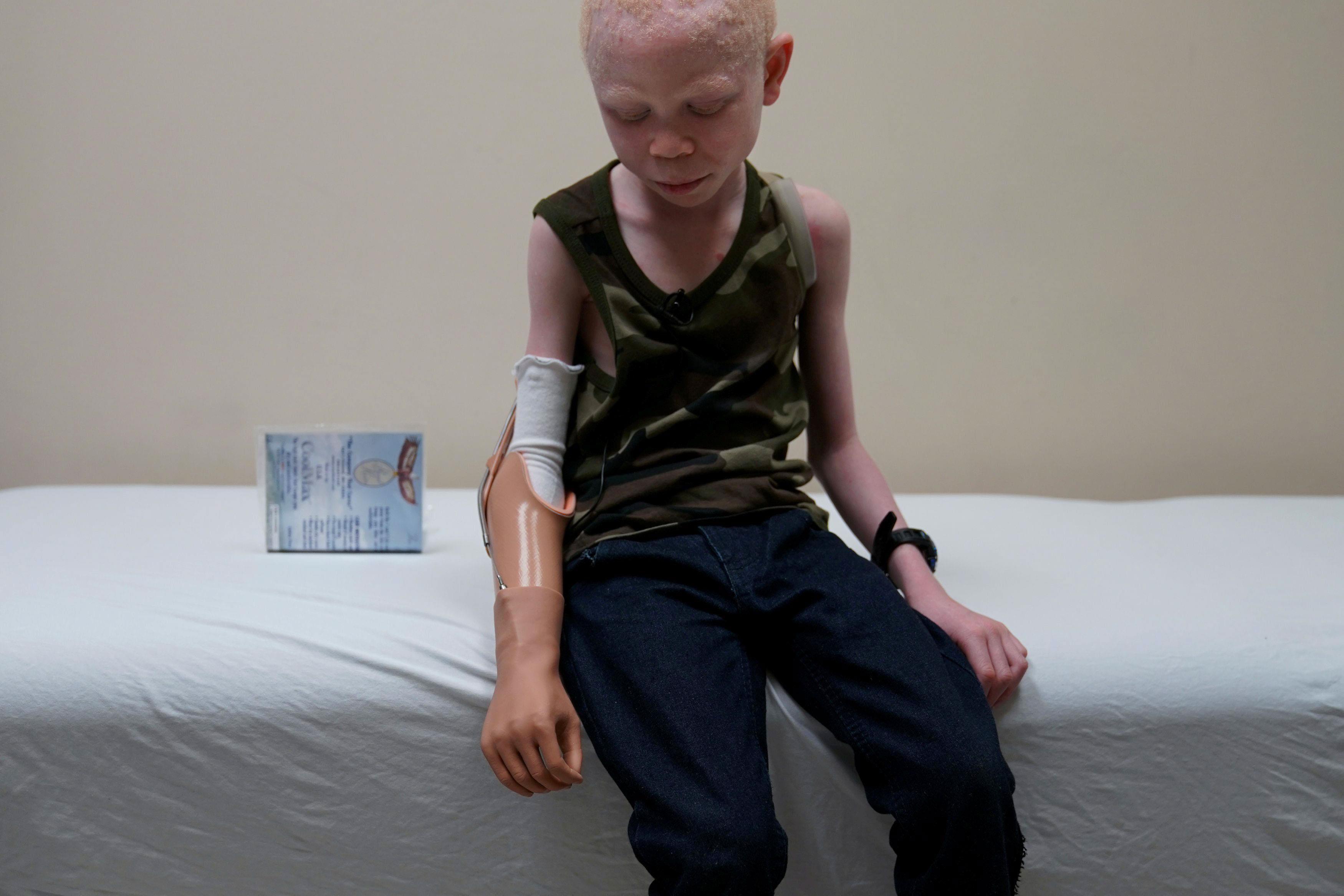 Baraka Lusambo, a Tanzanian with Albinism who had his arm chopped off in a superstition-driven attac