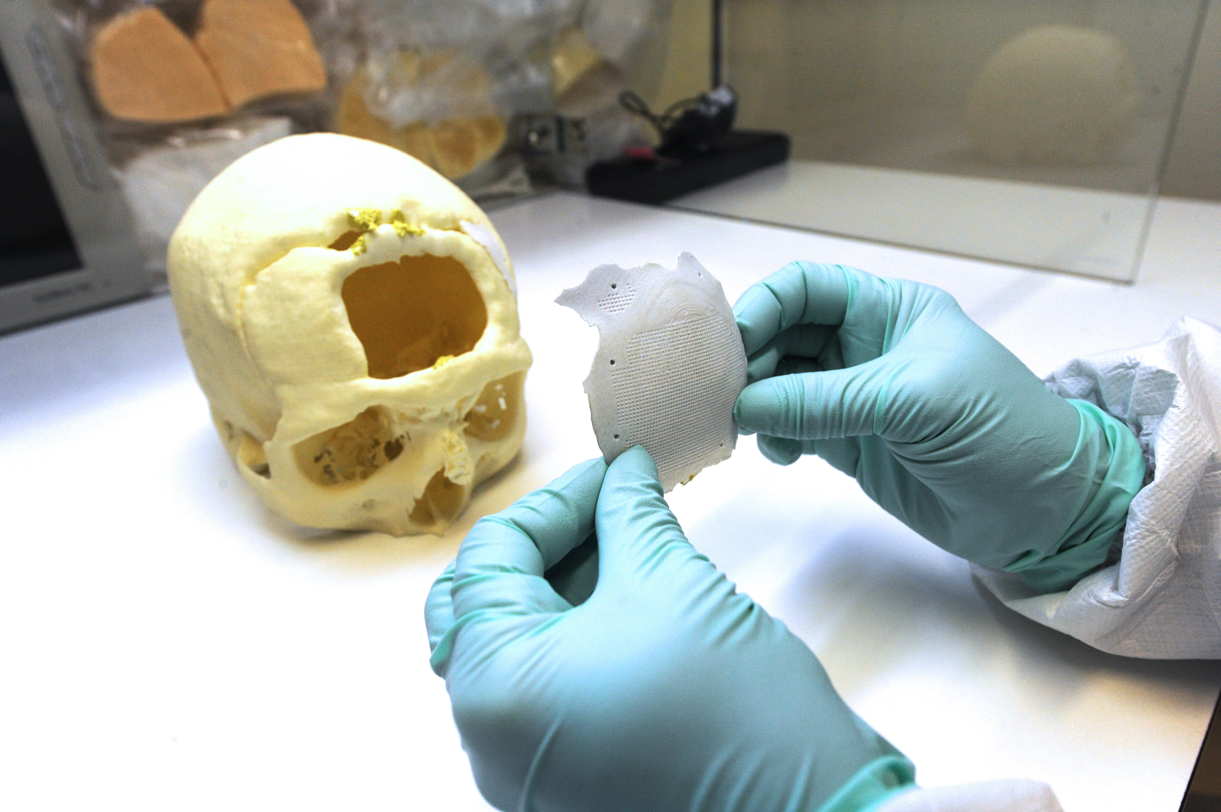 Orvosi csoda: 3D-s nyomtatóval készítettek homlokprotézist egy betegnek -  Blikk