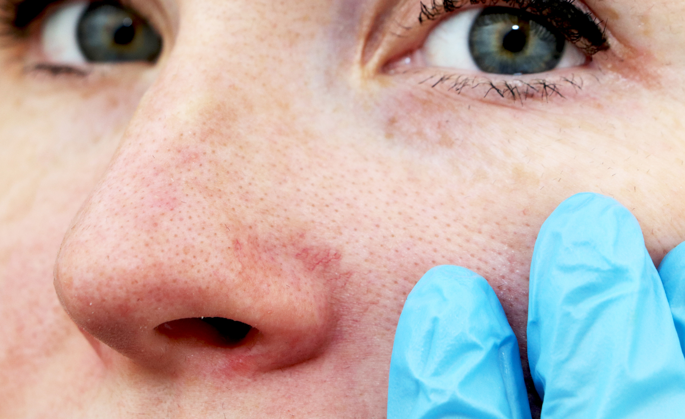 Pókhálóerek az orron és az arcon - ez a bőrgyógyász tanácsa rosacea esetén  | EgészségKalauz