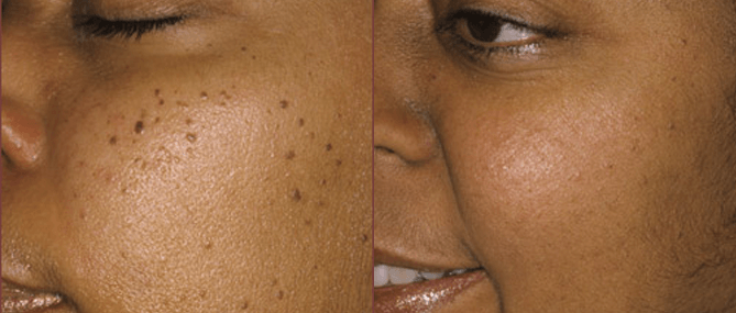 How to prevent skin tags: Safe methods of removal