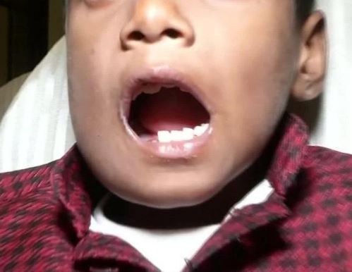 Doctors discover 526 extra teeth in 7-year-old boy’s mouth (photos)