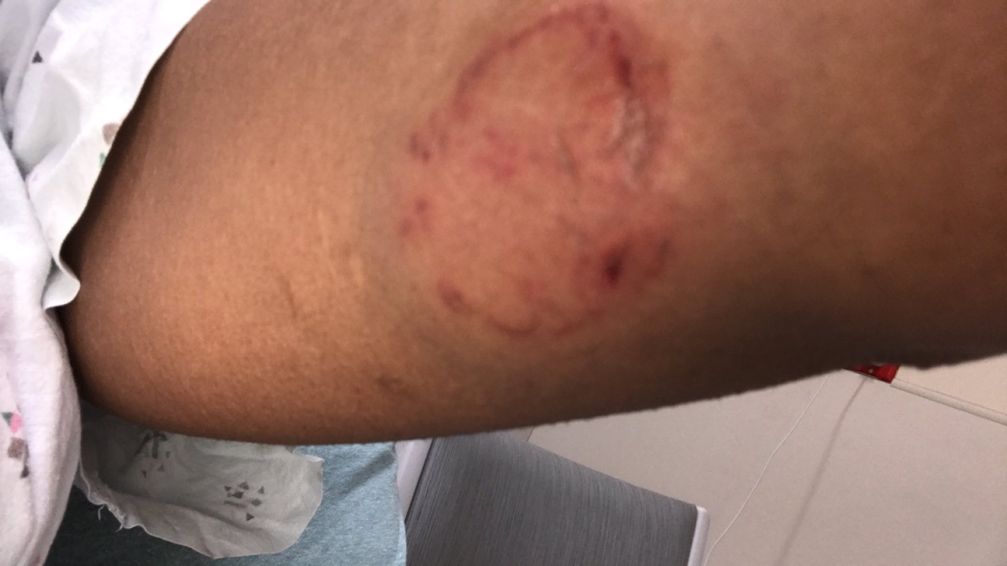 Lesbians displays bruises suffered from partner, urges colleagues to seek help (photos)