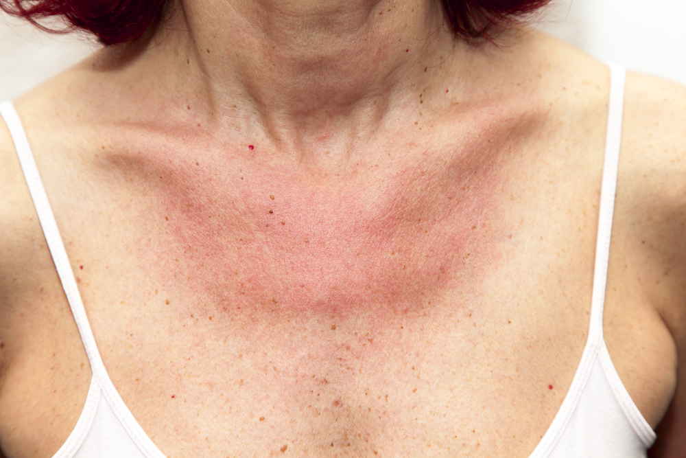kiütés a bőrön vörös foltok formájában felnőtteknél a nyakon
