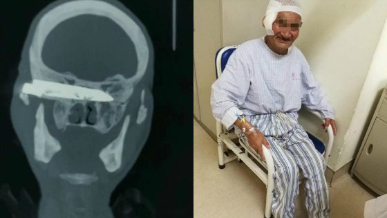 Doctors remove 4-inch-long rusty knife from man’s head 26 years after he was stabbed (photos)