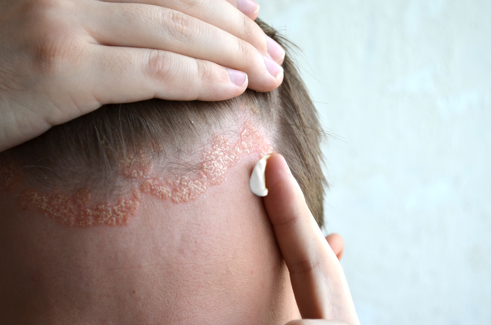 Pikkelysömör (pszoriázis, psoriasis) tünetei és kezelése - HáziPatika