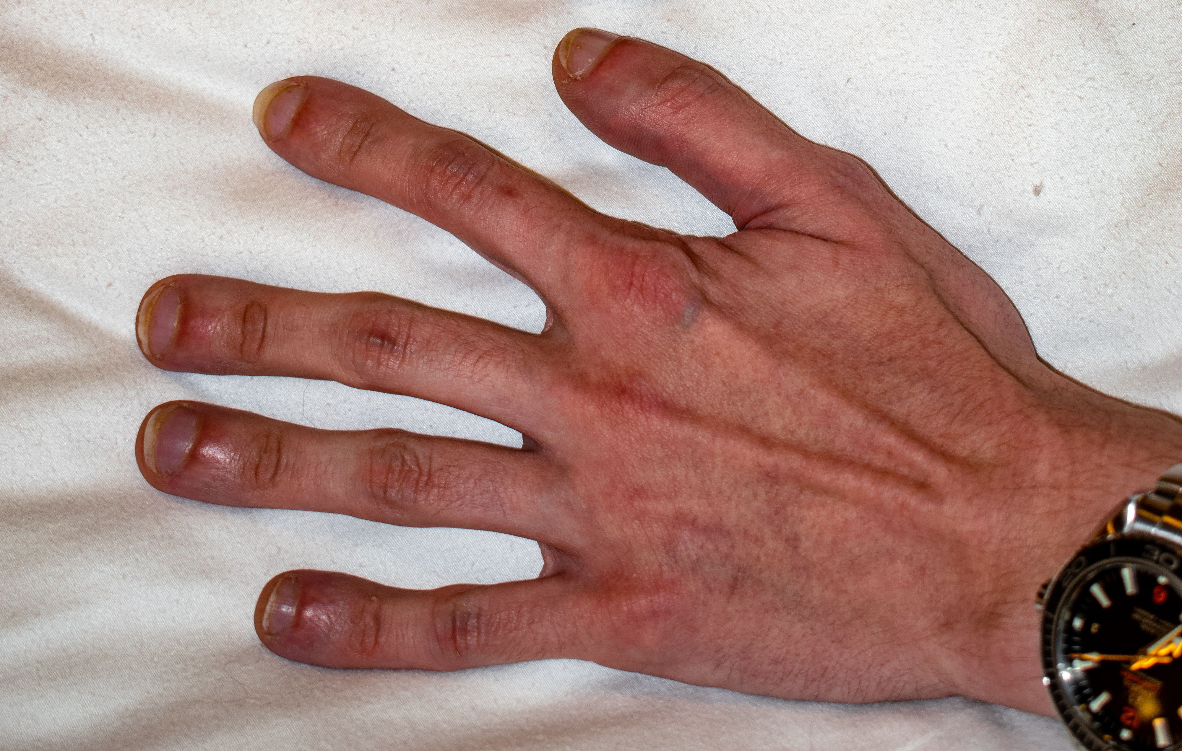 Ha így néznek ki az ujjai, az súlyos tüdőbetegség tünete is lehet |  EgészségKalauz
