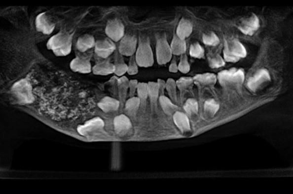 Doctors discover 526 extra teeth in 7-year-old boy’s mouth (photos)