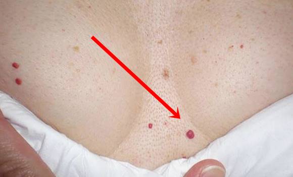 mit jelentenek a kis vörös foltok a bőrön psoriasis rash treatment
