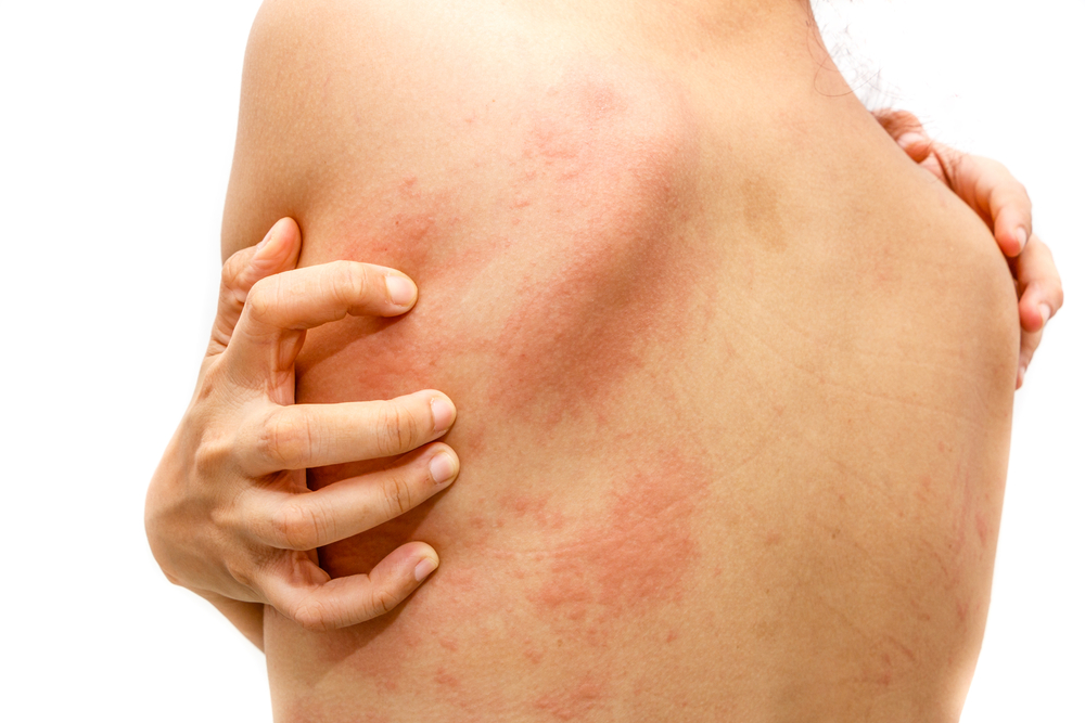 bőrbetegségek viszkető kiütések