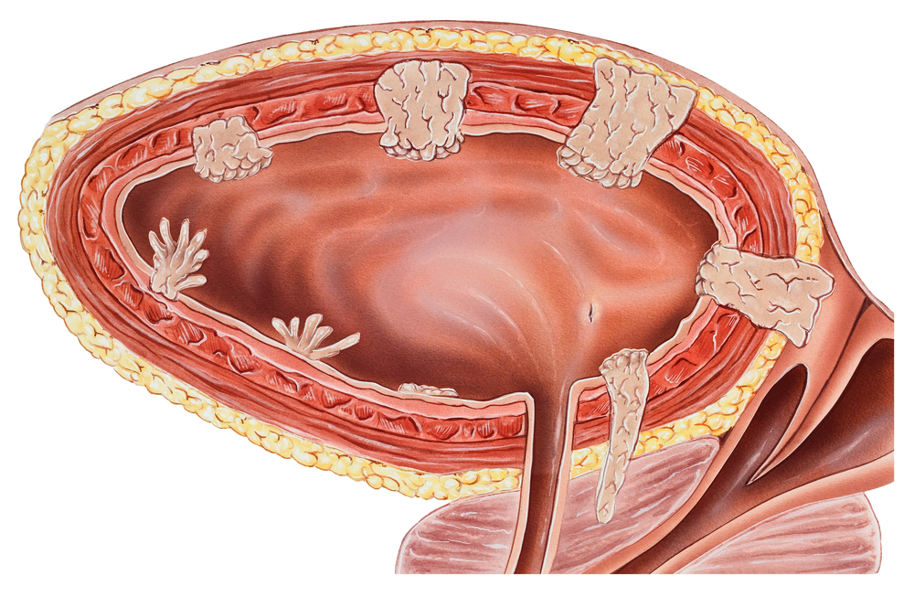 húgyhólyag papillomatosis