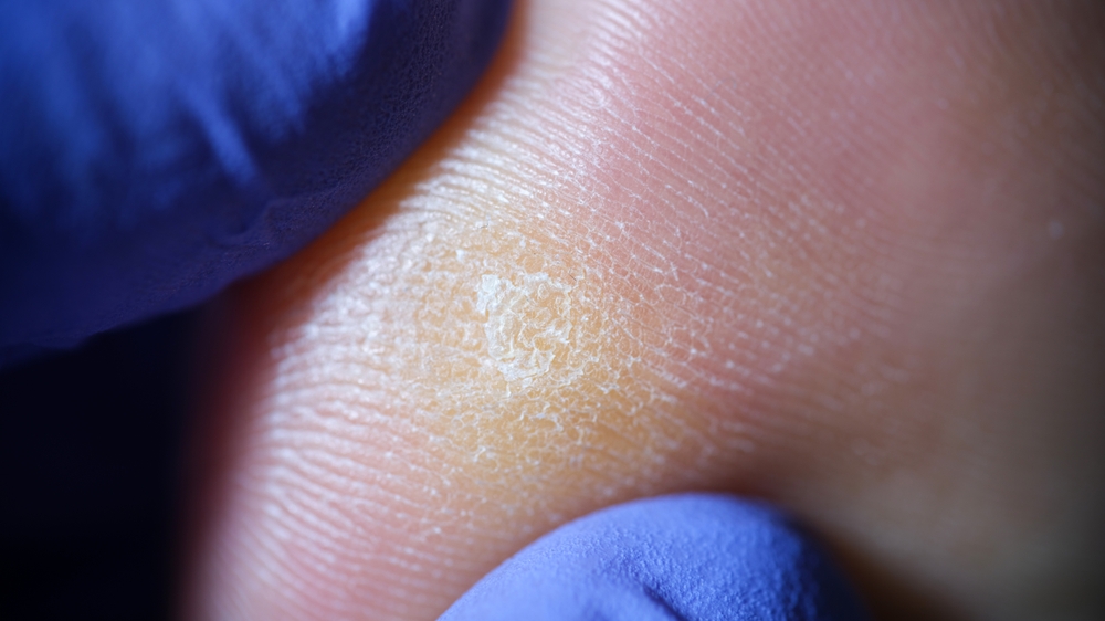 Bőrkeményedés - ezeket a betegségeket előre jelezheti | EgészségKalauz