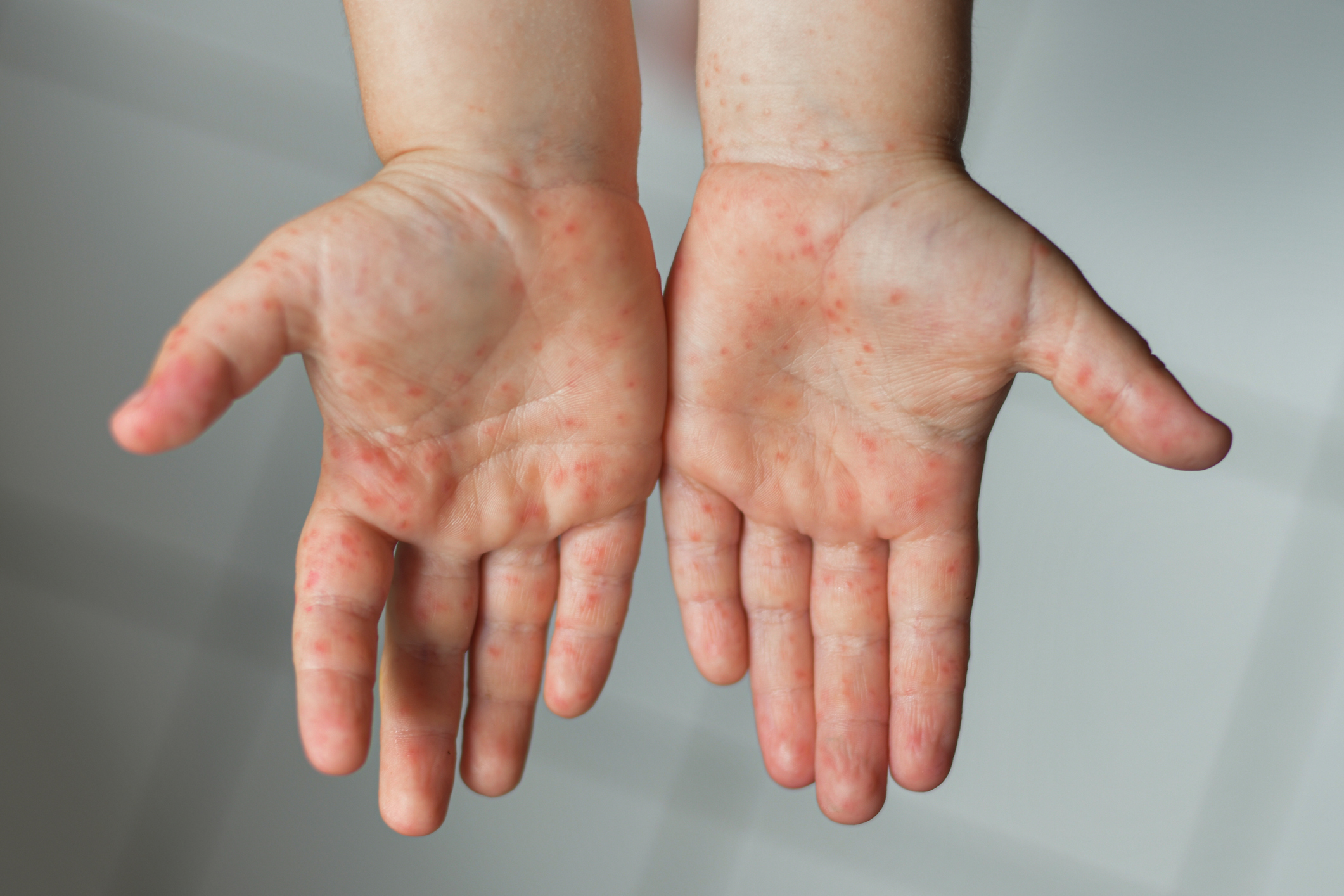 Láz és fájdalmas kiütések - újabb betegség terjed a gyerekek között |  EgészségKalauz