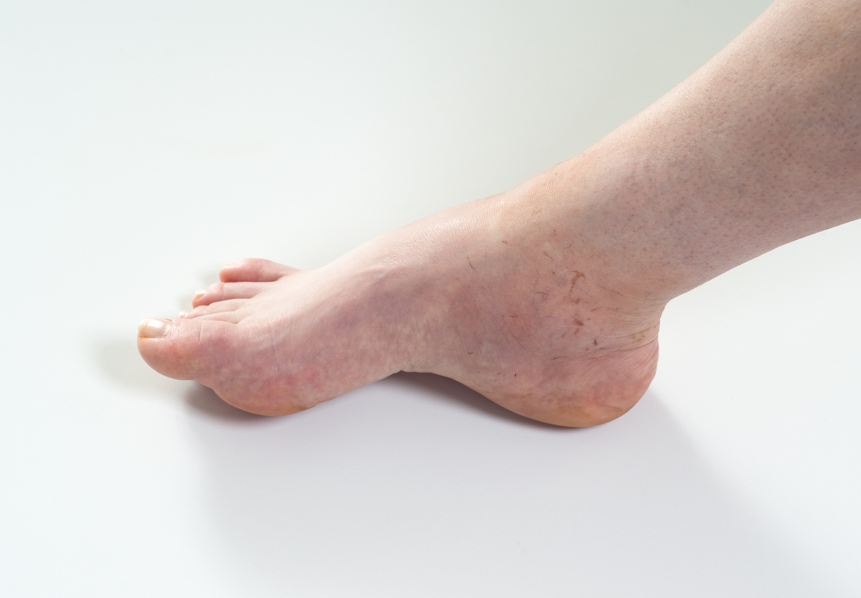 a lábak kötőszövetének gyulladása a térd bursitisz synovitisának kezelése