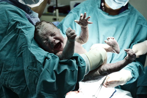 C-section