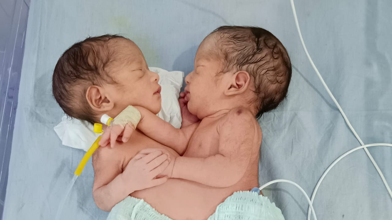 Hasuknál összenőtt fiúkat szült egy 22 éves nő, de azt sem tudta, hogy ikreket vár – fotók