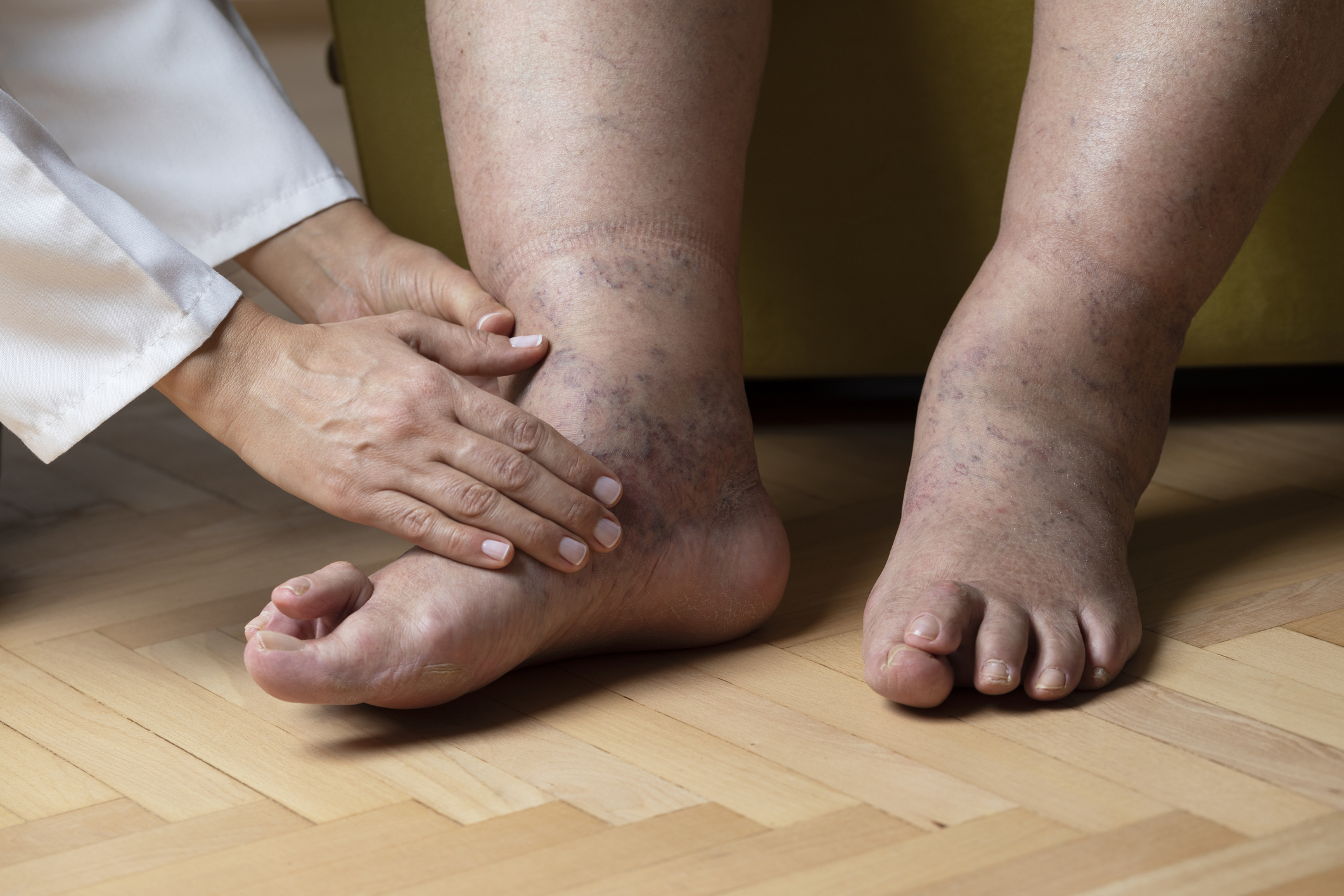 a duzzadt lábak természetes kezelése