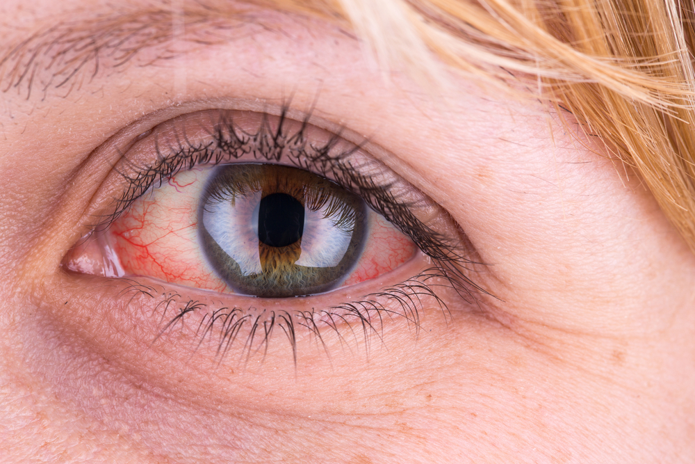 ha a szem alatt vörös pikkelyes foltok vannak kátránykezelés pikkelysömörhöz