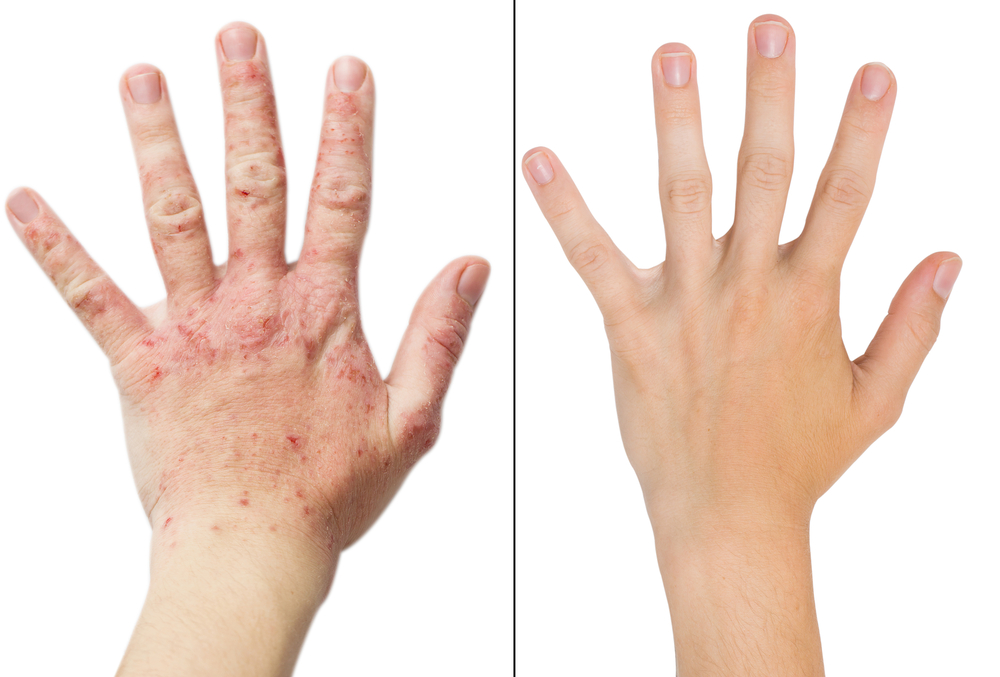 atópiás dermatitis kezelése gyógynövényekkel