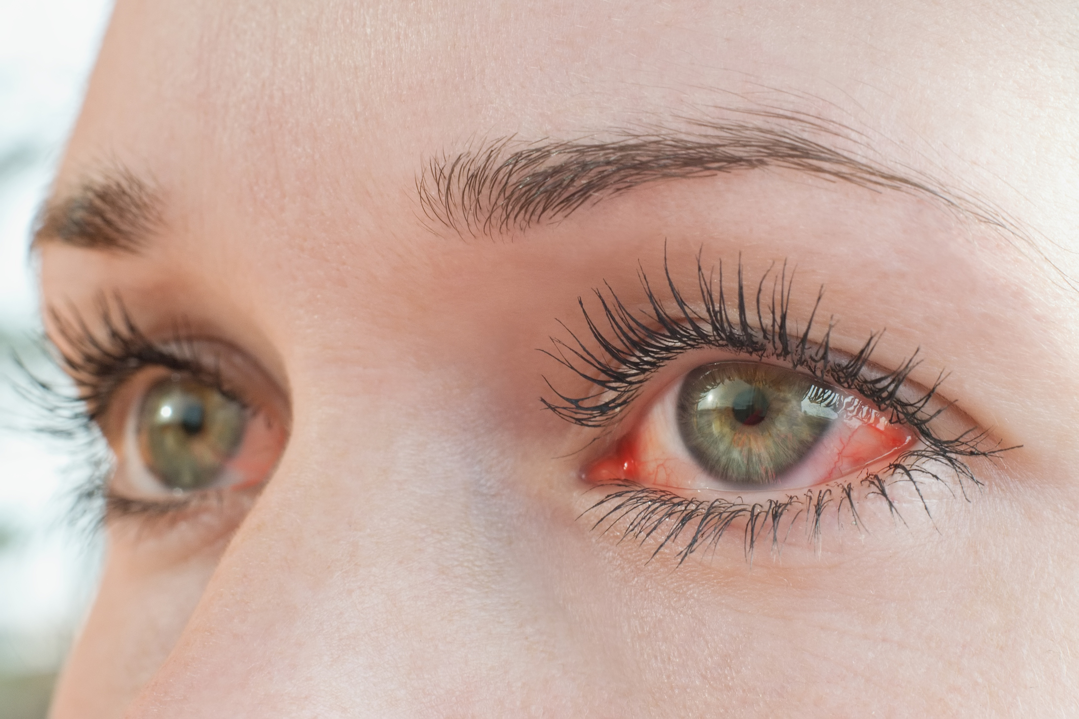 Ha így fáj a szeme, azonnal forduljon orvoshoz | EgészségKalauz