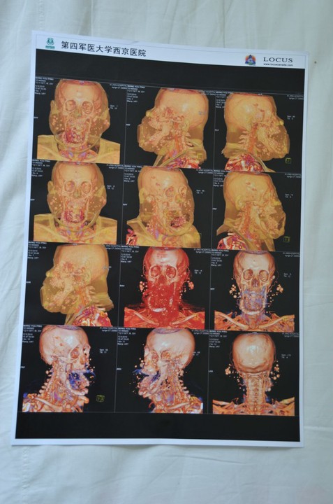 شخص لا يغلق فمه منذ 21 عاماً بسبب تضخم لسانه شخص لا يغلق فمه منذ 21 عاماً بسبب تضخم لسانه