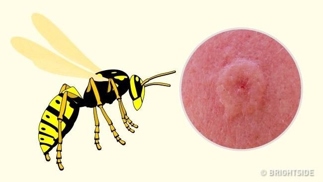 6 dolog, amit AZONNAL tenni kell, ha egy méh vagy darázs csípett meg, és 3 dolog, amit sürgősen felejts el