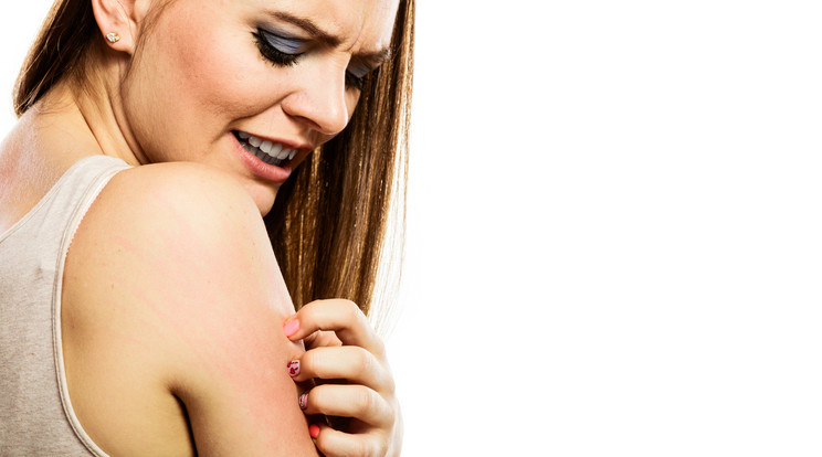 A viszketés lehet az egyik allergiás tünet / Fotó: Shutterstock