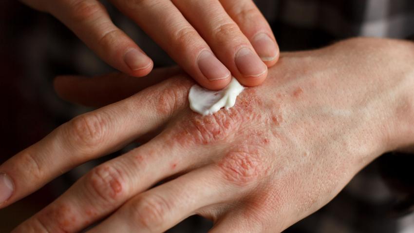 ekcéma oka dermatitis atópiás ekcéma gyógynövények