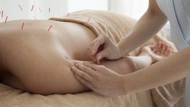 Akupunktura - na co pomaga i kiedy nie można jej stosować?