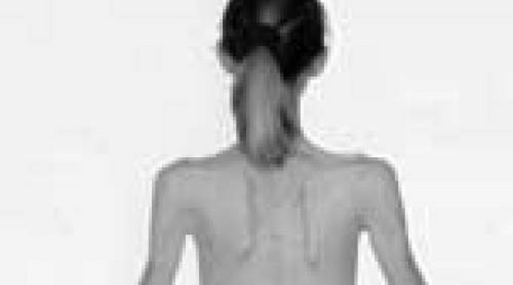 Horror! Csonttá fogyott az anorexiás nő
