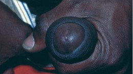 Chlamydia Trachomatis - typy serologiczne. Jakie choroby może wywoływać Chlamydia Trachomatis?