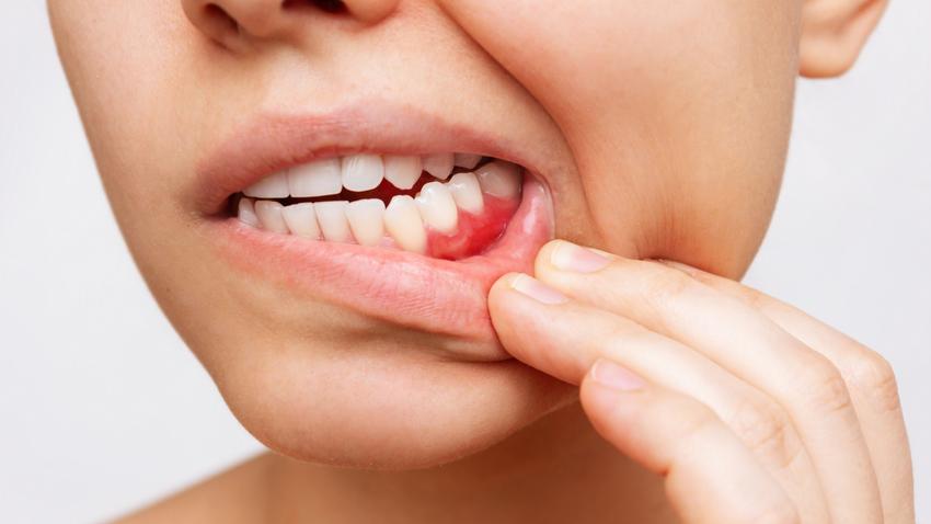 Vérző, érzékeny fogíny romló fogak daganat