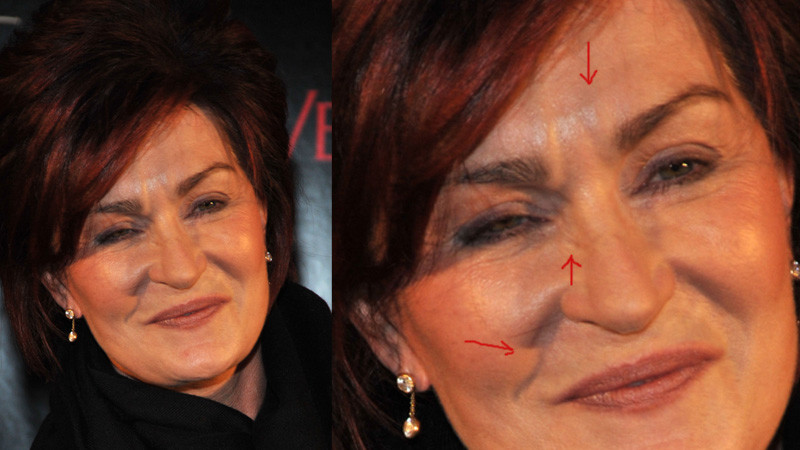 Sharon Osbourne wstrzykuje sobie BOTOKS